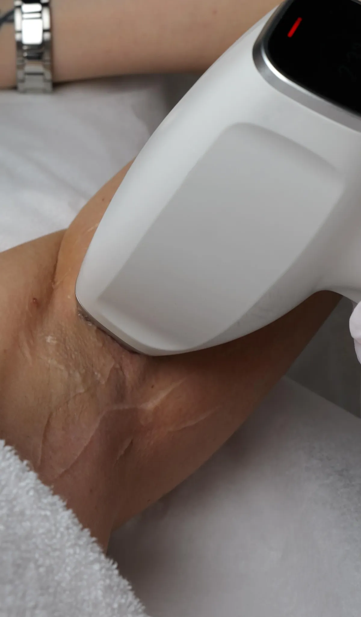 Permanent hårborttagning med laser i Katrineholm